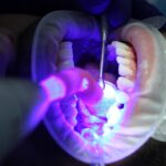 Riscos associados ao clareamento dos dentes