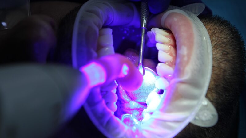 Riscos associados ao clareamento dos dentes